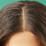 How to Get Rid of Dandruff- Afro Glamour Cosmetic