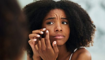 How to get gid of pimples and Acne- Afro Glamour Cosmetics